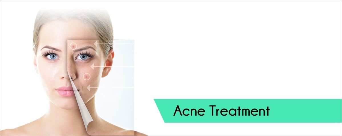 Acne Treatment