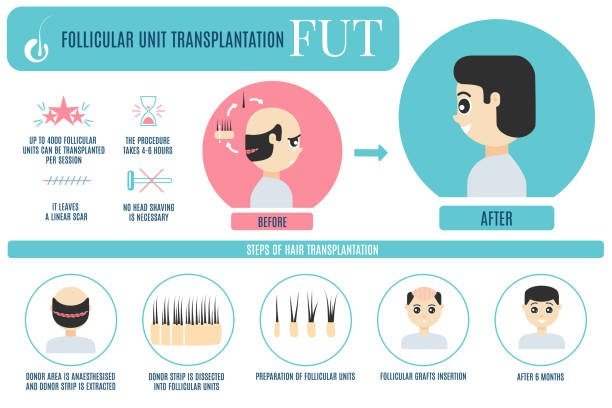 Process of FUT Hair Transplant
