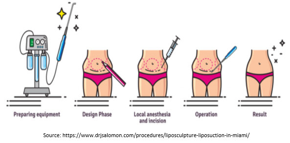 By opting for liposuction under local anesthesia, you can achieve your  ideal body shape in just 2-3 hours. The procedure involves the u