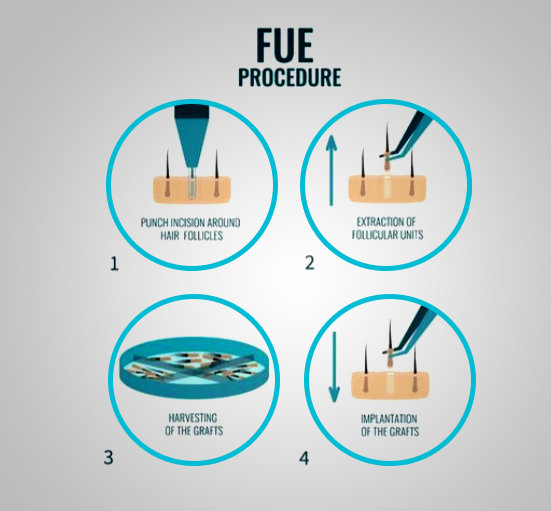 FUE Hair Transplant in Jaipur