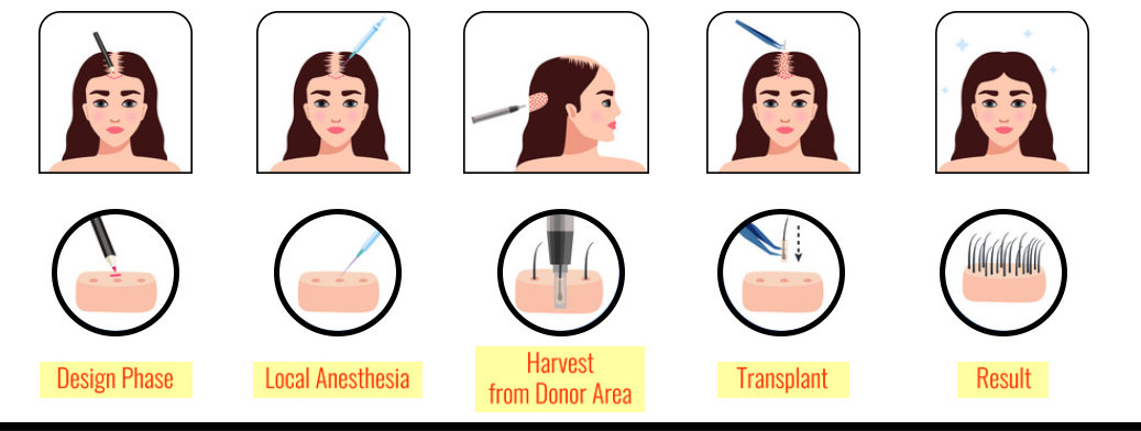 Female hair transplant in Jaipur