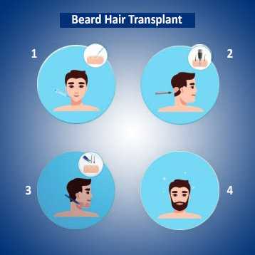 Beard transplant in Jaipur