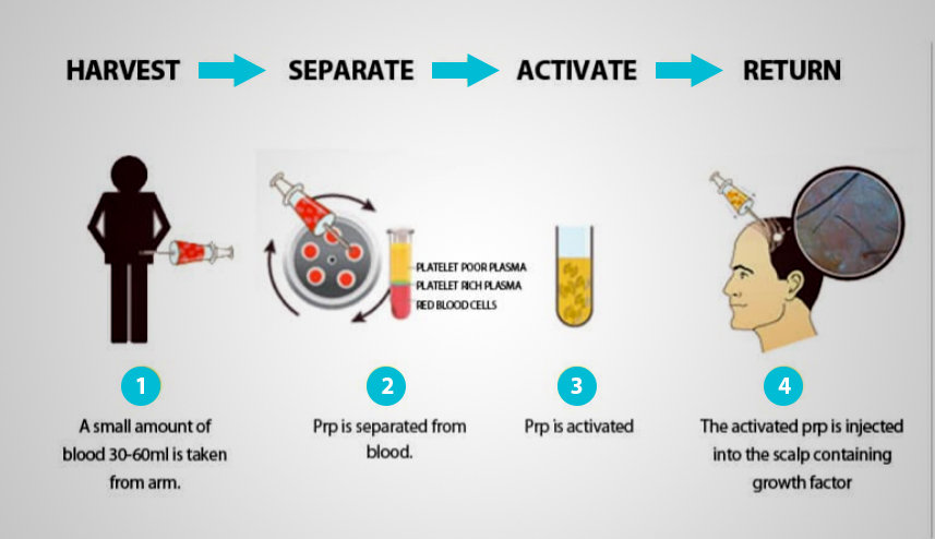 PRP treatment in Jaipur