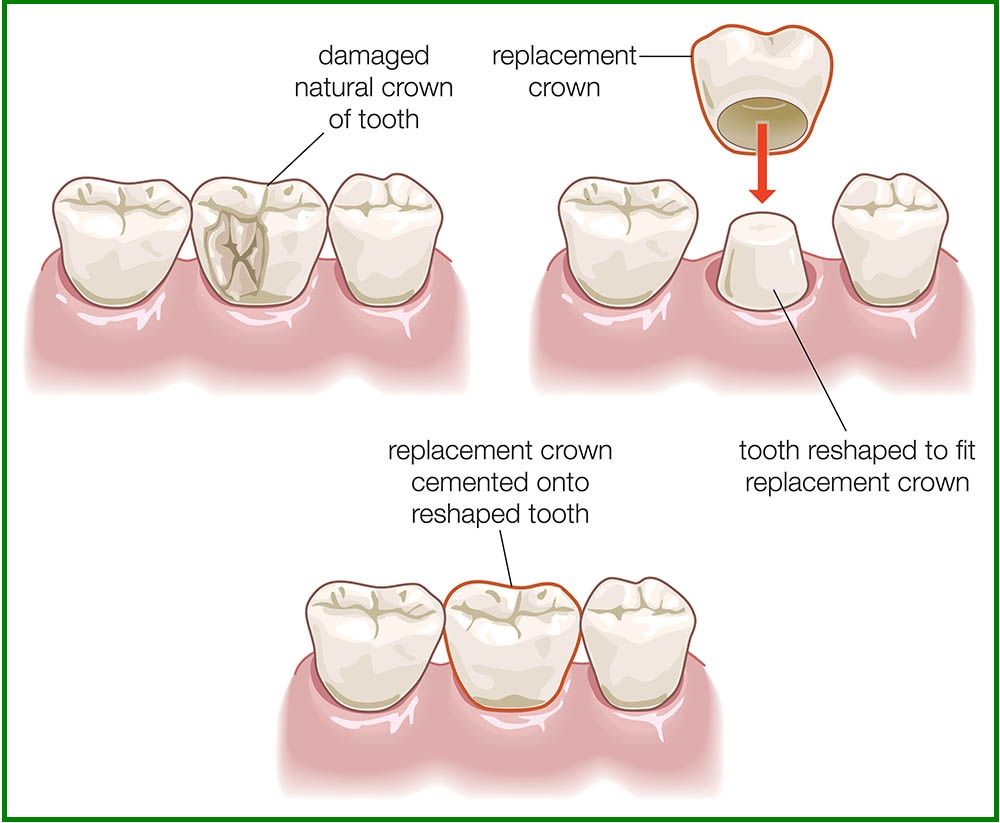 procedure of dental crown treatment