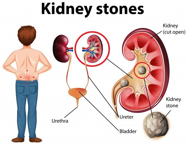 Kidney Stone Treatment