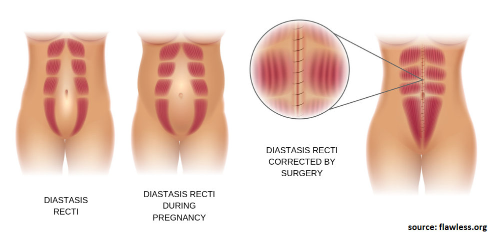 What is The Difference Between Liposuction and Tummy Tuck?