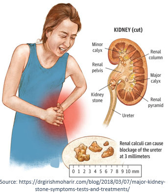 kidney stones