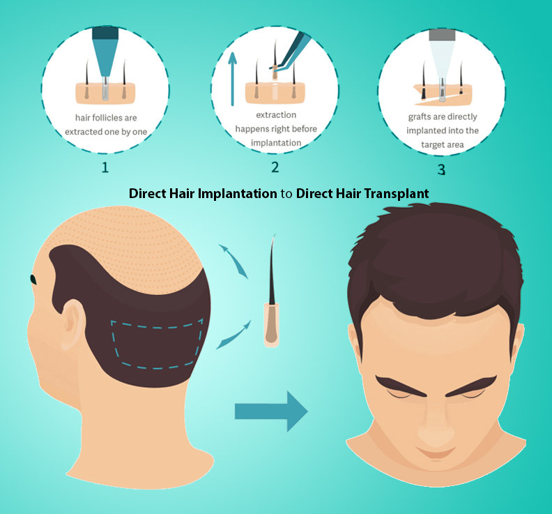 direct hair transplant in Jaipur