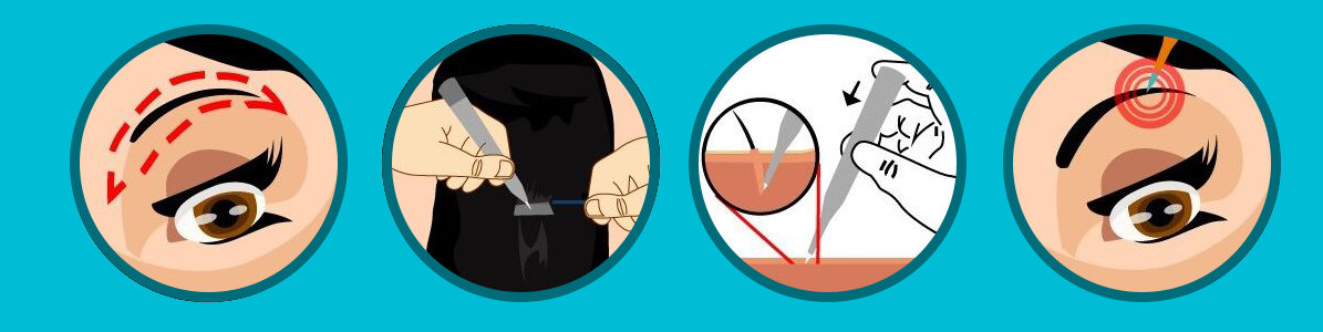 eyebrow transplant in Jaipur