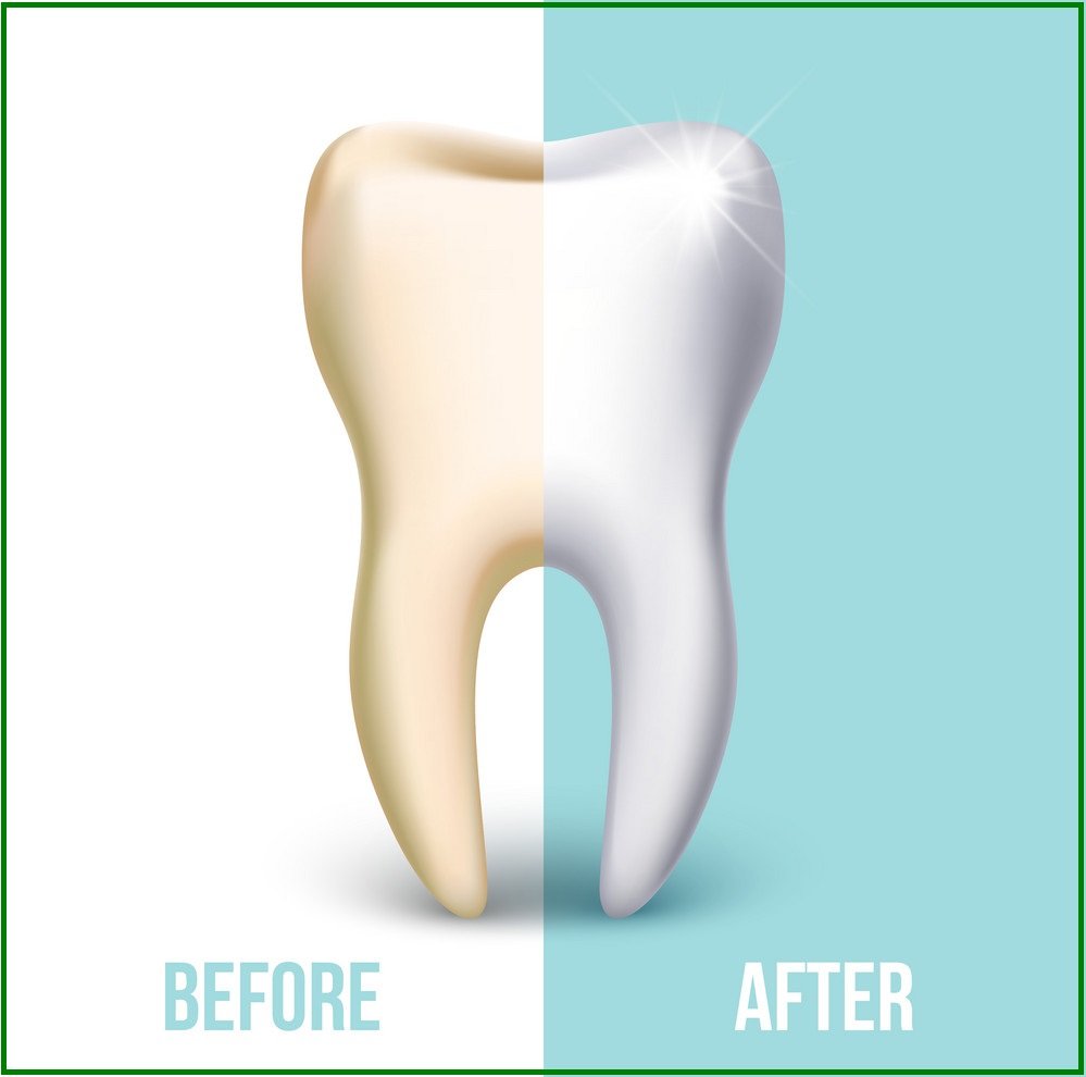 teeth whitening benefits