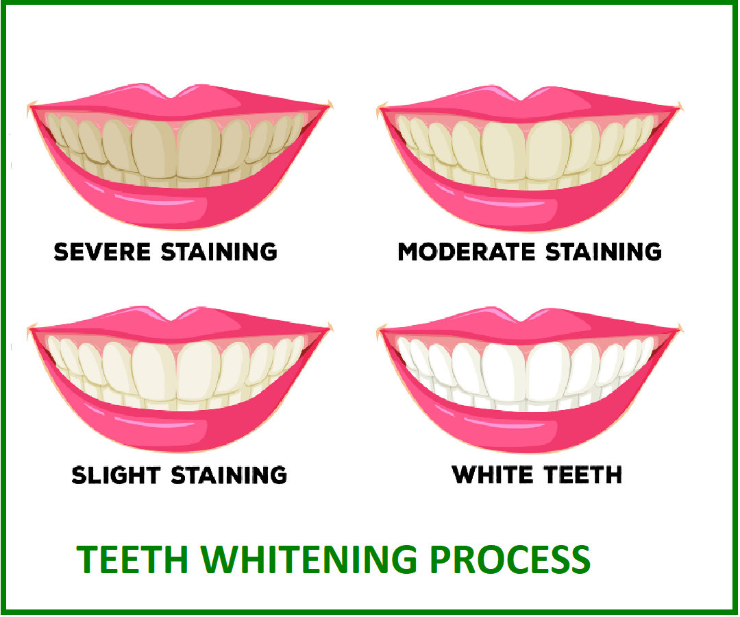 teeth whitening process