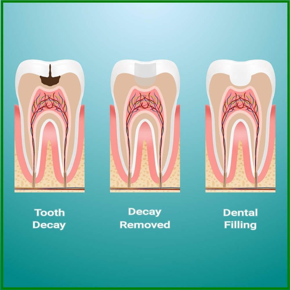 procedure of dental filling