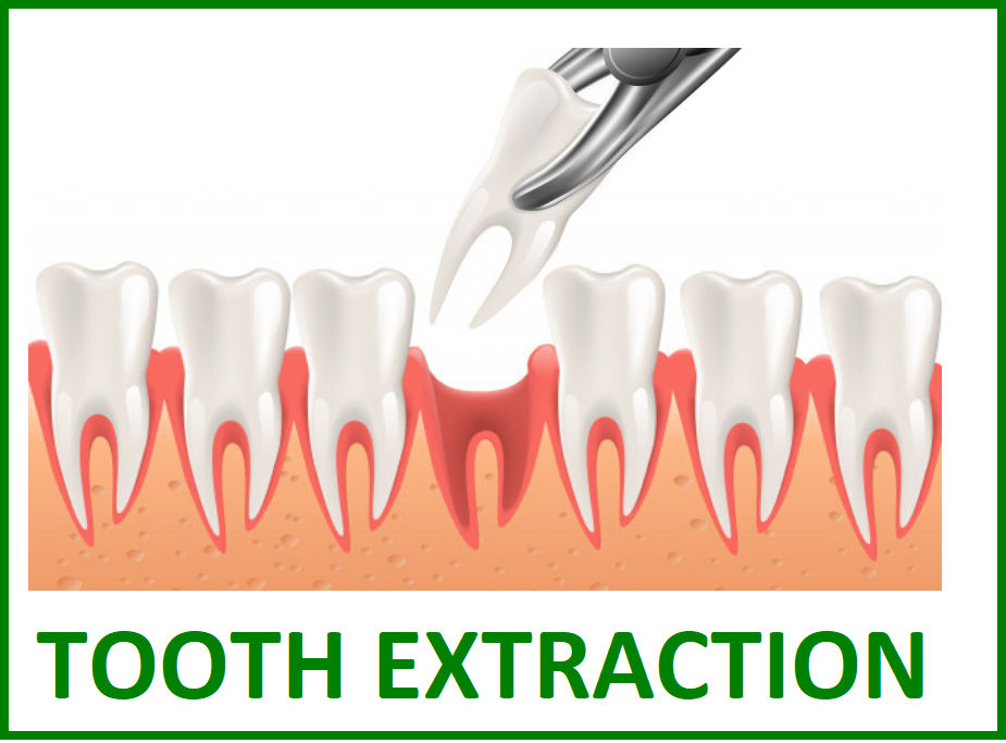 tooth extraction in Nungambakkam