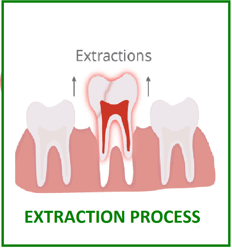 procedure for tooth extraction