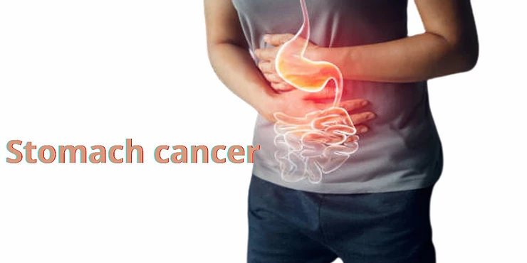 Stomach cancer - All you need to know Stomach cancer - All you need to know