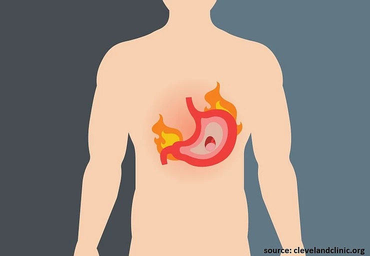 Gastritis- Everything you need to know Gastritis- Everything you need to know