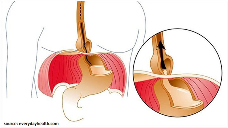 Hiatal Hernia and How it Causes Acid Reflux Hiatal Hernia and How it Causes Acid Reflux
