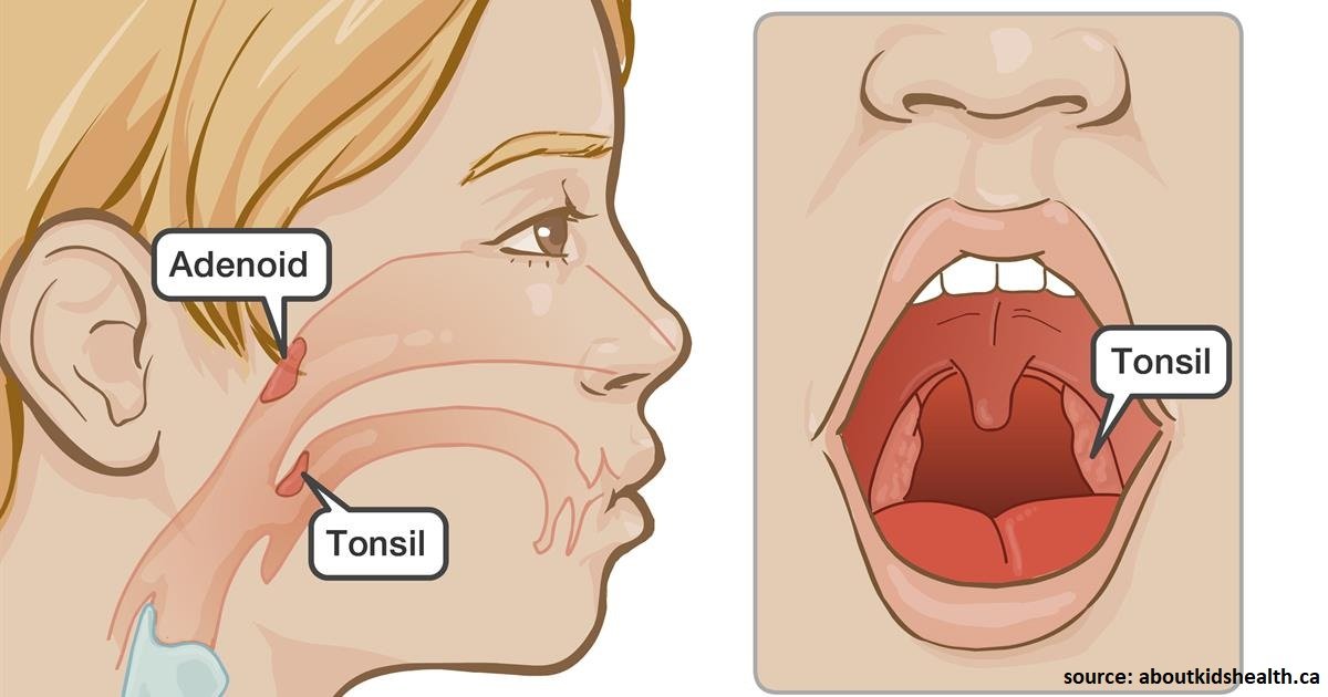 Get Rid of Tonsil Stones - Causes, Symptoms, Treatment, Removal and Other  Remedies by Diana Thorgill M.D(2013-08-13): Amazon.com: Books