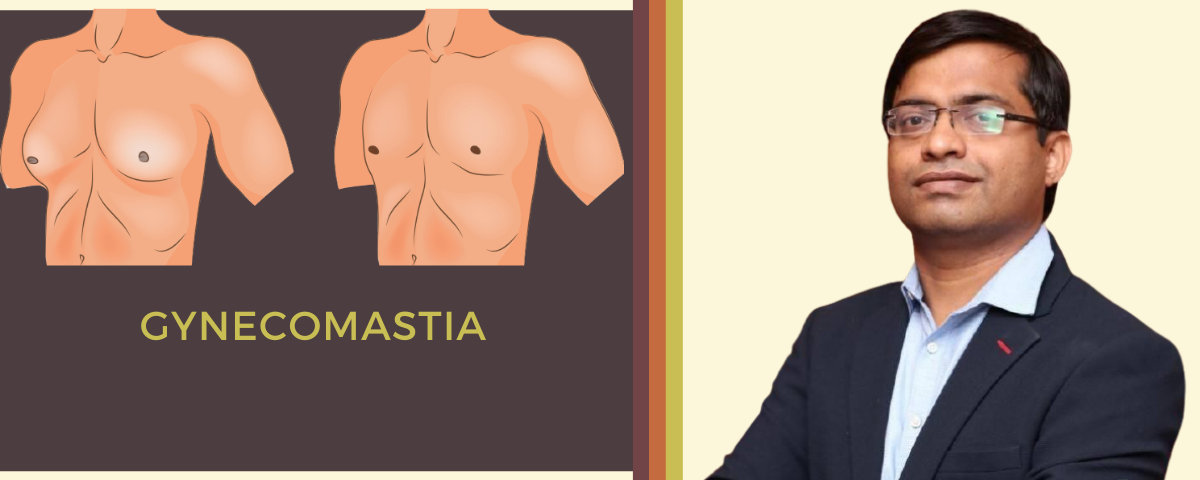 Gynecomastia treatment