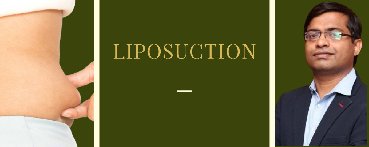 Liposuction Treatment