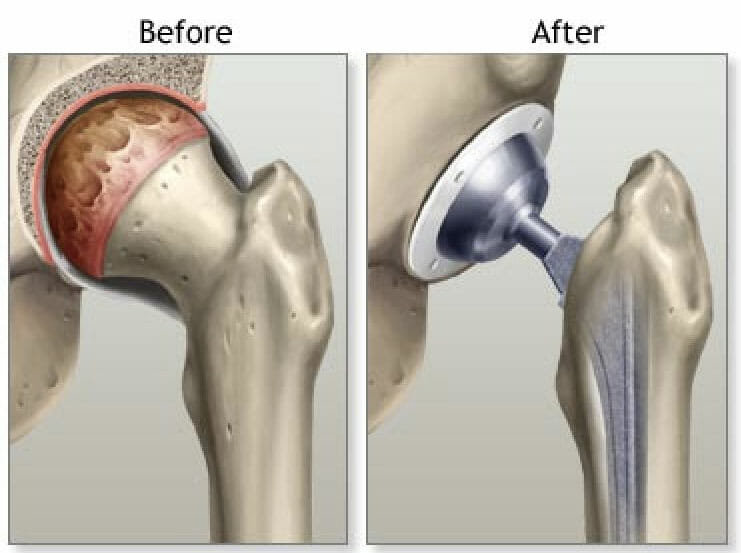 Total joint replacement surgery