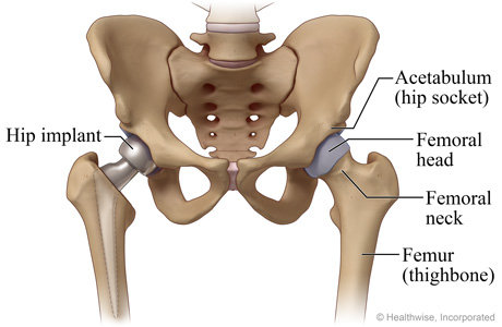 Hip replacement surgery