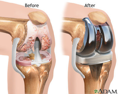 Knee replacement surgery