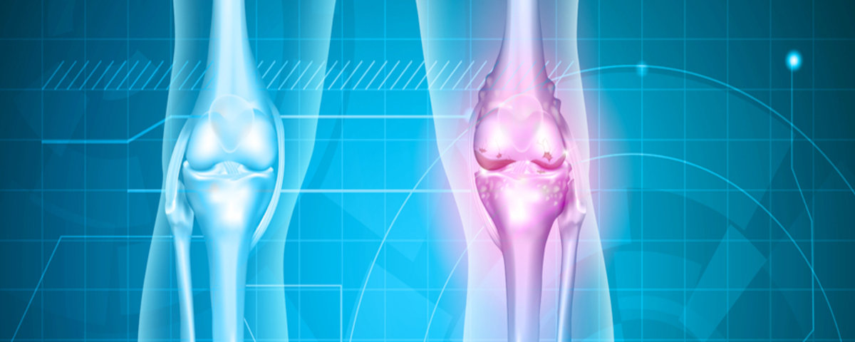 Joint Replacement Joint Replacement