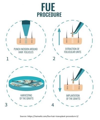 Follicular Unit Extraction