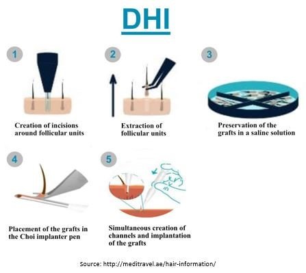 Direct Hair Transplant