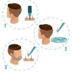 Procedure for Beard Hair Transplant