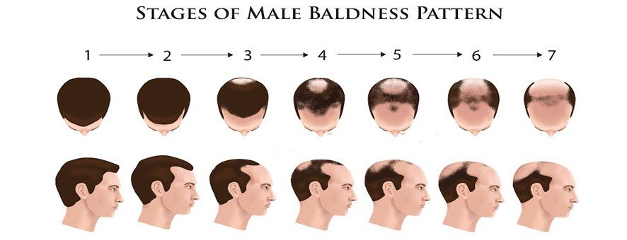 Stages of male pattern baldness