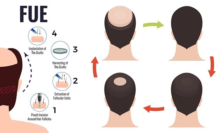 best FUE hair transplant