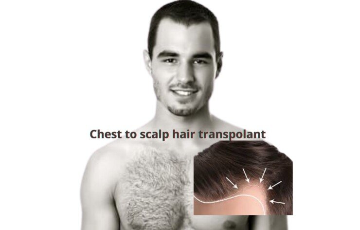 Body hair transplant
