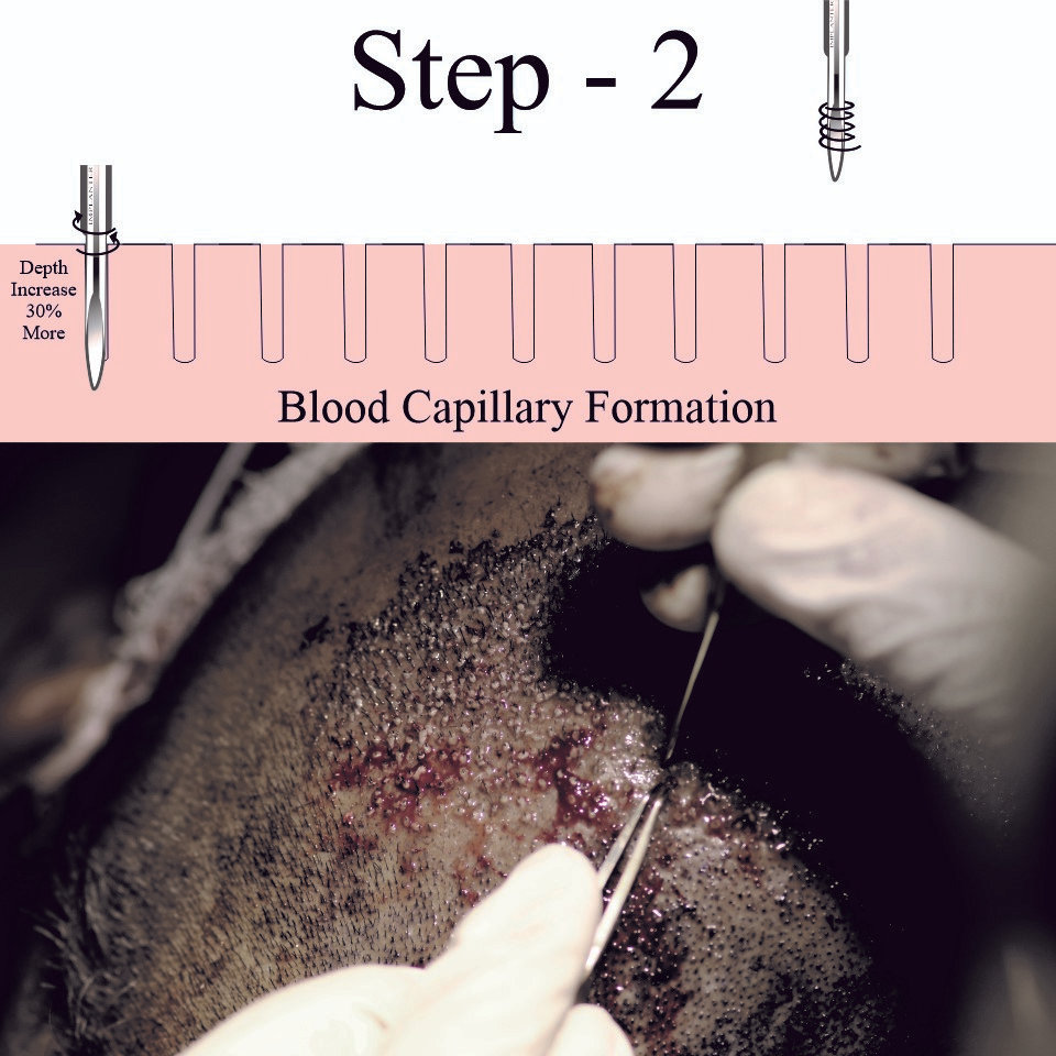 Two-Step DHI method