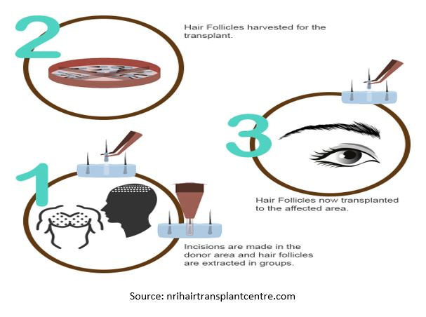 How Eyelash Hair Transplant performed