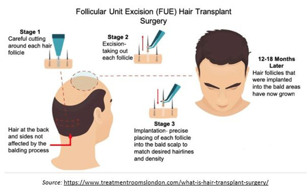 Follicular Unit Extraction