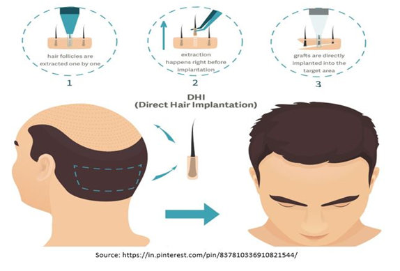 Direct Hair Implantation