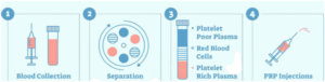 Steps of PRP