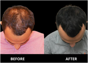 PRP before After