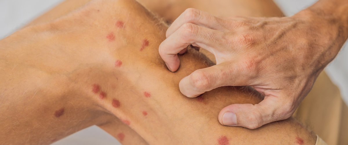 Skin Allergies Treatment Skin Allergies Treatment