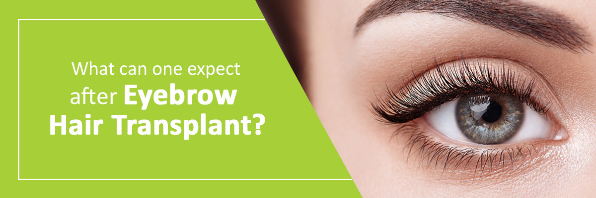 What can one expect after eyebrow hair transplant? What can one expect after eyebrow hair transplant?