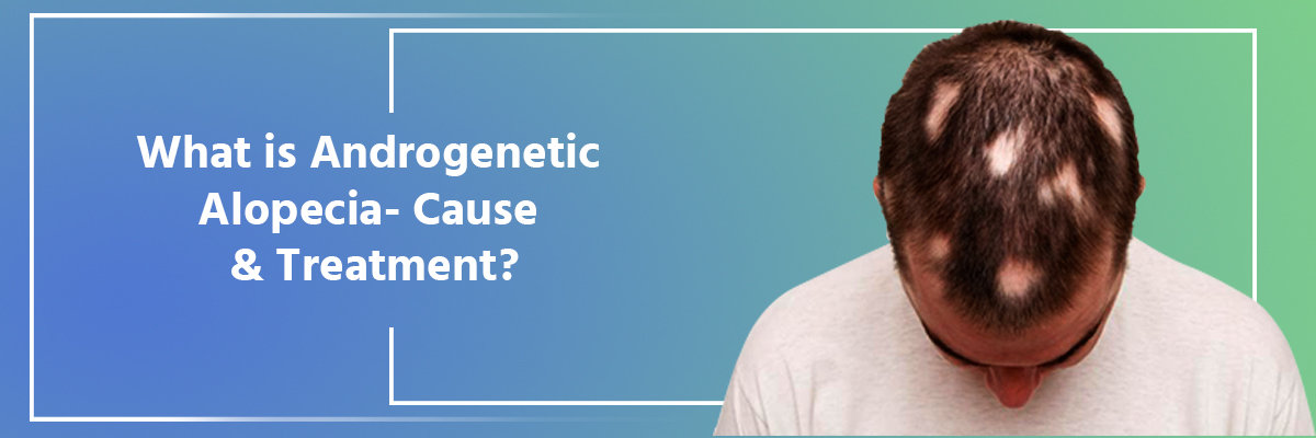 What is Androgenic Alopecia What is Androgenic Alopecia