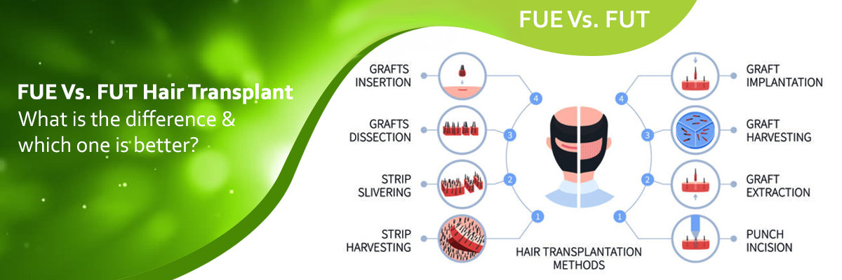 FUE Vs. FUT hair transplant: What is the difference & which one is better? FUE Vs. FUT hair transplant: What is the difference & which one is better?