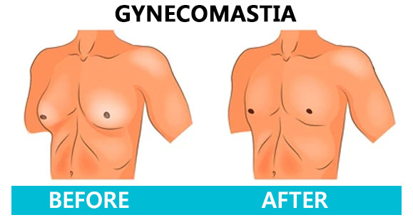 Gynecomastia