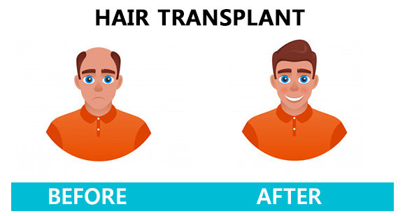 Hair transplant