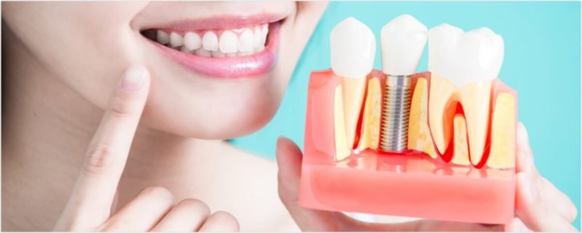 Dental Implants Dental Implants