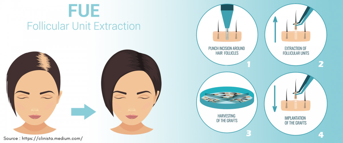 FUE hair restoration process FUE hair restoration process