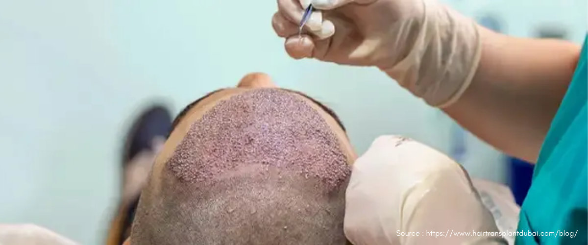 Remove Scabs after a Hair Transplant Remove Scabs after a Hair Transplant