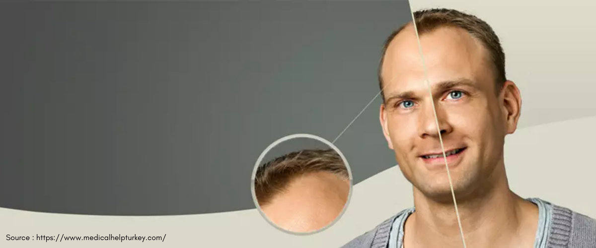 Great Hair Transplant Great Hair Transplant